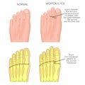 Morton`s toe