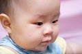 Mosquito bite Asian baby girl Royalty Free Stock Photo