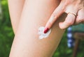 Mosquito bite on the leg. Insects in the summer. Dangerous nature. Itchy body. Girl is applying cream on the swell skin. Medical Royalty Free Stock Photo