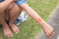 Mosquito bites arm women ,in the park. Royalty Free Stock Photo