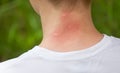 Mosquito bites. Girl with blond hair, sitting with his back to turn. Close-up of visible red, swollen neck skin from mosquito bite Royalty Free Stock Photo