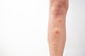 Mosquito bites on the leg. Mosquito bites close up shot Royalty Free Stock Photo