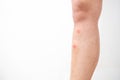 Mosquito bites on the leg. Mosquito bites close up shot Royalty Free Stock Photo