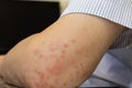 Mosquito bits skin of man`s elbow, creating a large area of bump, itching, swelling, soreness, and redness. hand cannot help