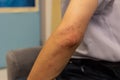 Mosquito bits skin of man`s elbow, creating a large area of bump, itching, swelling, soreness, and redness. hand cannot help