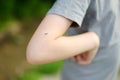 Mosquito sitting on the hand of child. Gnat sucking blood. Danger of bite of an insect. Use repellent for safety kids