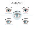 Most common eye problems - conjunctivitis, glaucoma, dry eye syndrome, barley eyes.