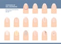 Most Common Nail Disorders and Diseases. Big set. Vector illustration