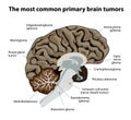 The most common primary brain tumors Royalty Free Stock Photo
