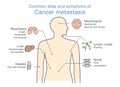 Most common sites and symptoms of Cancer Metastasis. Royalty Free Stock Photo