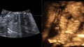 Motion of 4D Ultrasound Echography of baby un mother`s womb. Life concept, scientific discovery