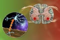 Motor neuron diseases, 3D illustration