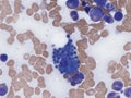 Mott cell in bone marrow. Royalty Free Stock Photo