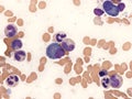 Mott cell in multiple myeloma. Royalty Free Stock Photo