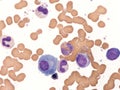 Mott cell in multiple myeloma. Royalty Free Stock Photo