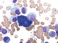 Multiple myeloma with foamy Mott cell.