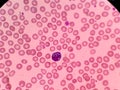 Mott cell - Plasmocyte. Blood smear. Red blood cells Royalty Free Stock Photo