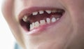 Mouth of a boy with missing tooth. Royalty Free Stock Photo