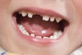 Mouth of a boy with missing tooth. Royalty Free Stock Photo