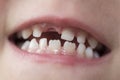 Mouth of a boy with missing tooth. Royalty Free Stock Photo