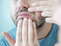 Man suffering for herpes simplex on the lips