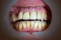 Mouth with four prosthetic upper teeth Royalty Free Stock Photo