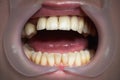 Mouth with four prosthetic upper teeth Royalty Free Stock Photo