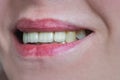 Mouth with four prosthetic upper teeth Royalty Free Stock Photo