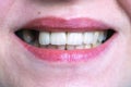 Mouth with four prosthetic upper teeth Royalty Free Stock Photo