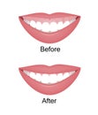 Mouth with a high smile line or gummy smile before and after the orthotropics, orthotropics or botox injections