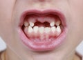 Mouth missing teeth Royalty Free Stock Photo
