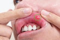 Mouth Ulcer Sore or Aphthous Stomatitis. Oral Health and Medical concepts