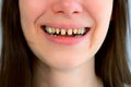 Mouth of young scary woman with yellow bad teeth smiling looking at camera.