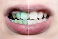 Mouthwash. Dental plaque. Teeth. Teeth before and after brushing and whitening in one photo. Dental hygiene