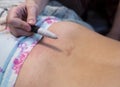 Moxibustion procedure at health centers. Alternative medicine therapist doing moxa treatment on her client.