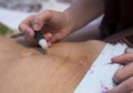 Moxibustion procedure at health centers. Alternative medicine therapist doing moxa treatment on her client.