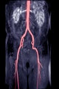 MRA Abdominal aorta with Abdominal aorta