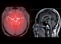 MRA Brain axial MIP view showing cerebral artery