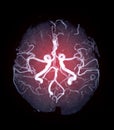 MRA Brain or Magnetic resonance angiography of the brain. Royalty Free Stock Photo
