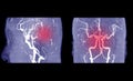 MRA brain or Magnetic resonance angiography of cerebral artery in the brain Sagittal MIP view