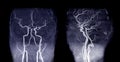 MRA Brain or Magnetic resonance angiography  MRA   of cerebral artery and common carotid artery AP and Lateral View . Royalty Free Stock Photo