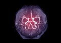 MRA Brain or Magnetic resonance angiography MRA of cerebral artery in the brain. Royalty Free Stock Photo