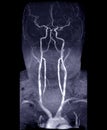 MRA Brain and neck or Magnetic resonance angiography MRA of cerebral artery and common carotid artery Royalty Free Stock Photo