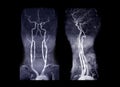 MRA Brain and neck or Magnetic resonance angiography MRA of cerebral artery and common carotid artery AP and Lateral View .