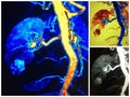 Mra lower pole renal cell carcinoma collage