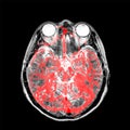 MRA (magnetic resonance angiography) of brain for stroke patient.