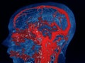 MRA AND MRV OF BRAIN Finding:Bilateral territorial muscles to the cortex and subcortical of the parietal and low hemispheres