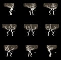 MRA AND MRV OF BRAIN History: A 61-year-old female, presented with intracranial hemorrhage