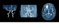 MRA AND MRV OF BRAIN