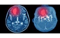 MRA AND MRV OF BRAIN Multiple acute intracranial hemorrhage at bilateral frontal lobes